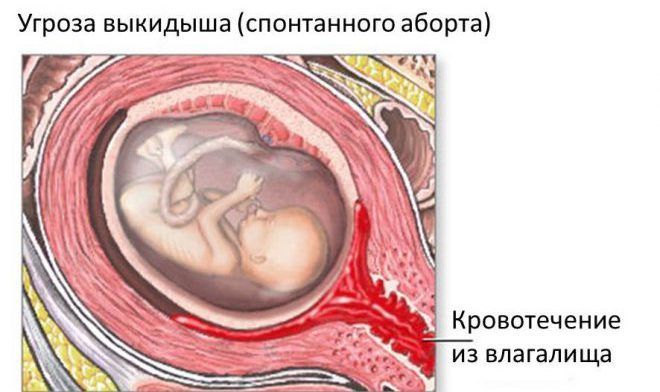 Гіпотиреоз при вагітності: субклінічний при щитовидній залозі, наслідки для дитини » журнал здоров'я iHealth 2