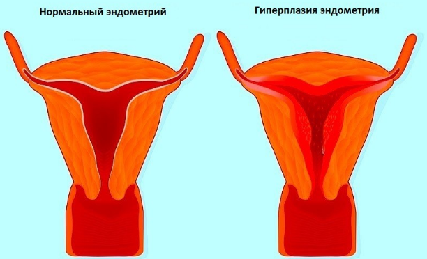 Ендометріоз - симптоми і лікування матки, що це таке доступним язиком? » журнал здоров'я iHealth 4