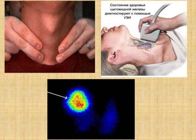 Кіста щитовидної залози у жінок - симптоми і лікування народними засобами » журнал здоров'я iHealth 7