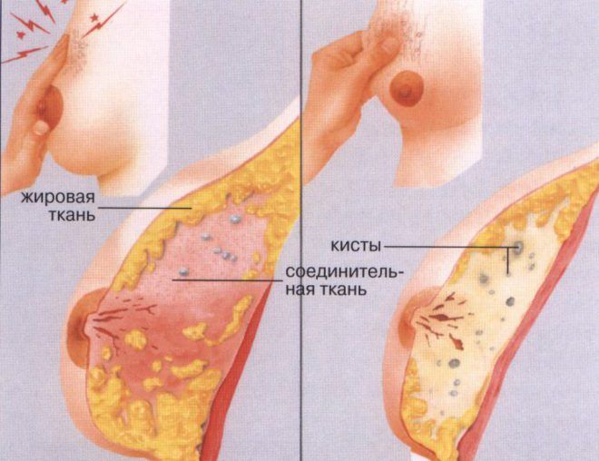 Гінекомастія у чоловіків, жінок та підлітків - лікування без операції » журнал здоров'я iHealth 1