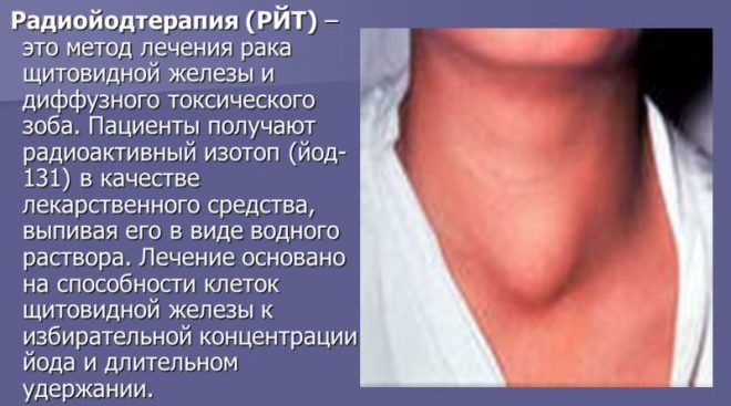 Вузловий зоб щитовидної залози –симптоми і лікування, що це таке? » журнал здоров'я iHealth 6