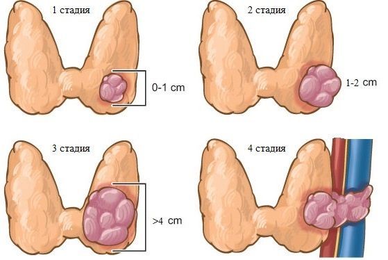 Медулярний рак щитовидної залози – карцинома, симптоми » журнал здоров'я iHealth 3