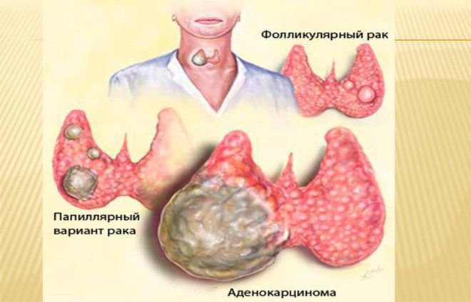 Фолікулярна пухлина щитовидної залози - що це таке, операція і лікування » журнал здоров'я iHealth 1