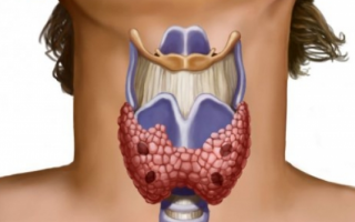 Диффузно-узловой тип зоба щитовидной железы