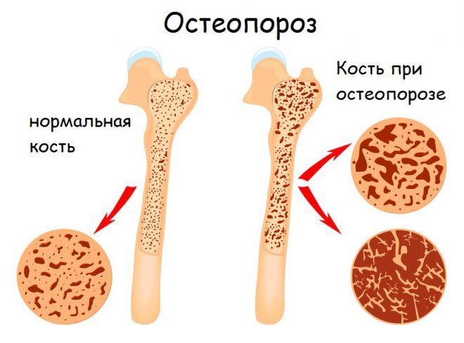 Гормональные препараты могут вызвать у вас остеопороз