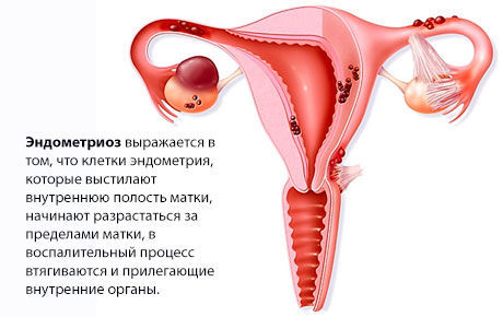 Эндометриоз тела матки
