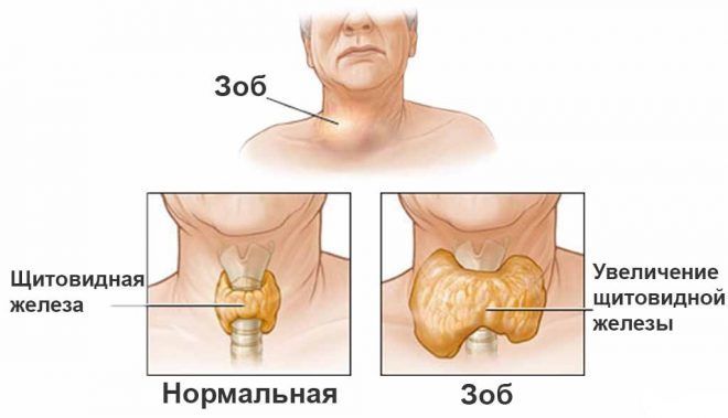 Пример увеличения щитовидной железы