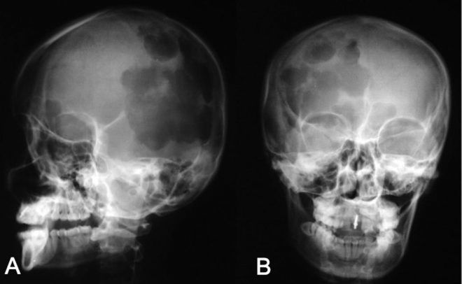 Рентгенография черепа