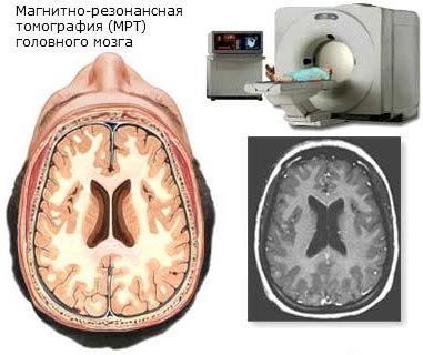 Томография мозга