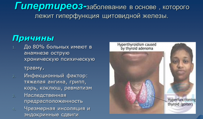 Гипертиреоз щитовидной железы