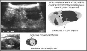 Изоэхогенное образование щитовидной железы
