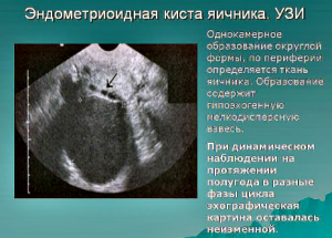 Эндометриозная киста яичника - диагностика